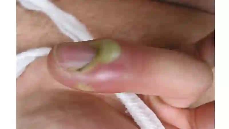 Seroz bòshliqlarning yiringli kasalliklari davolash minimal invaziv 4
