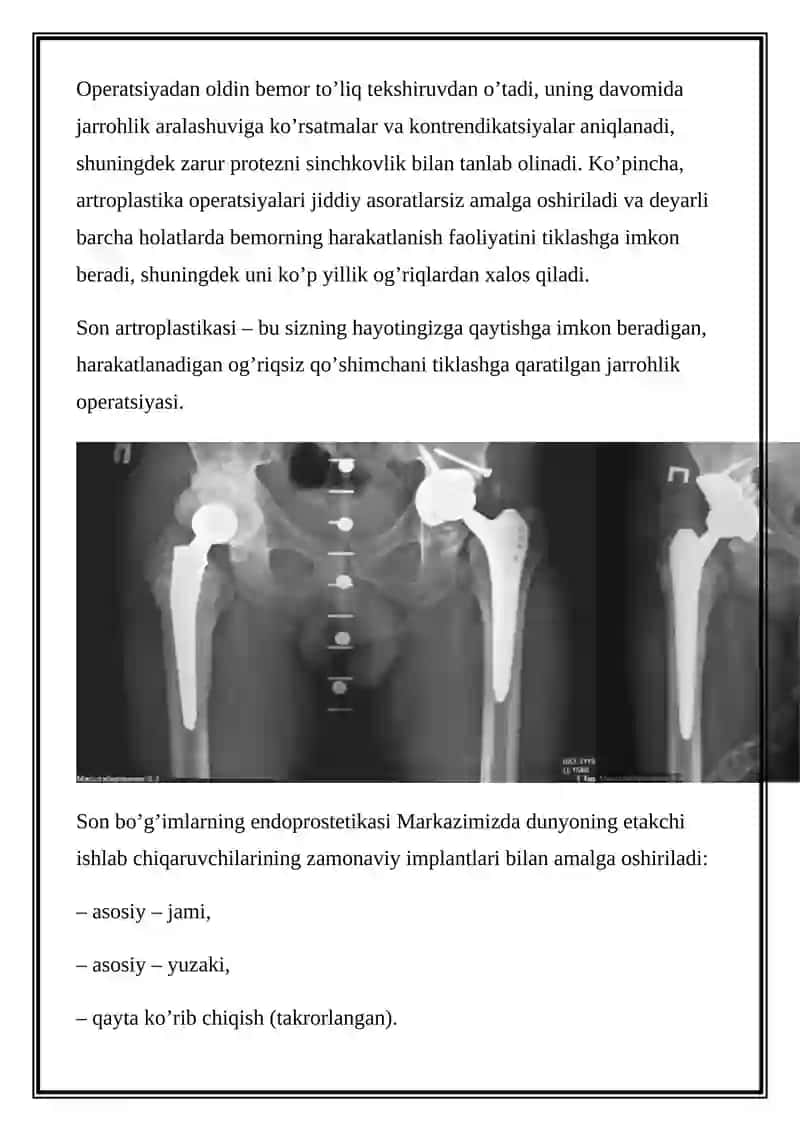 Endoprosthesis of large joints 4