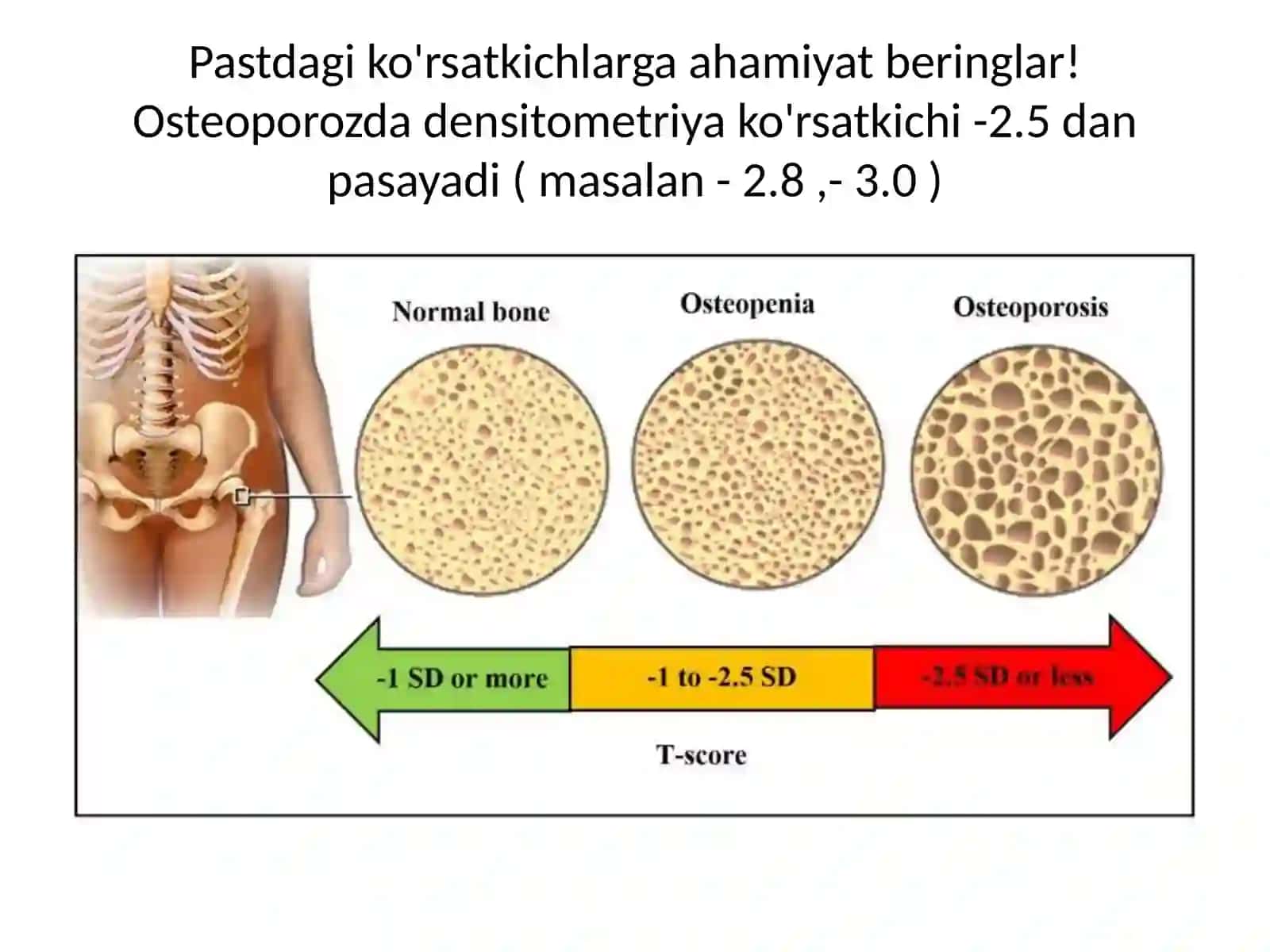 OSTEOPOROZ KASALLIGI 4