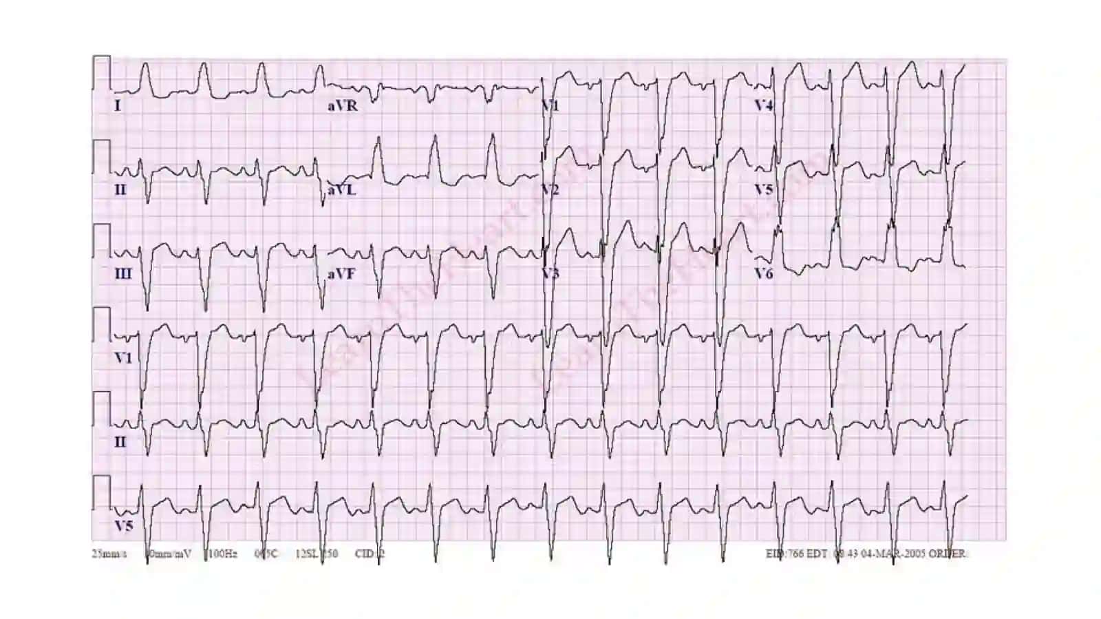 Koronar tomir yetishmovchiligidagi EKG belgilari 4