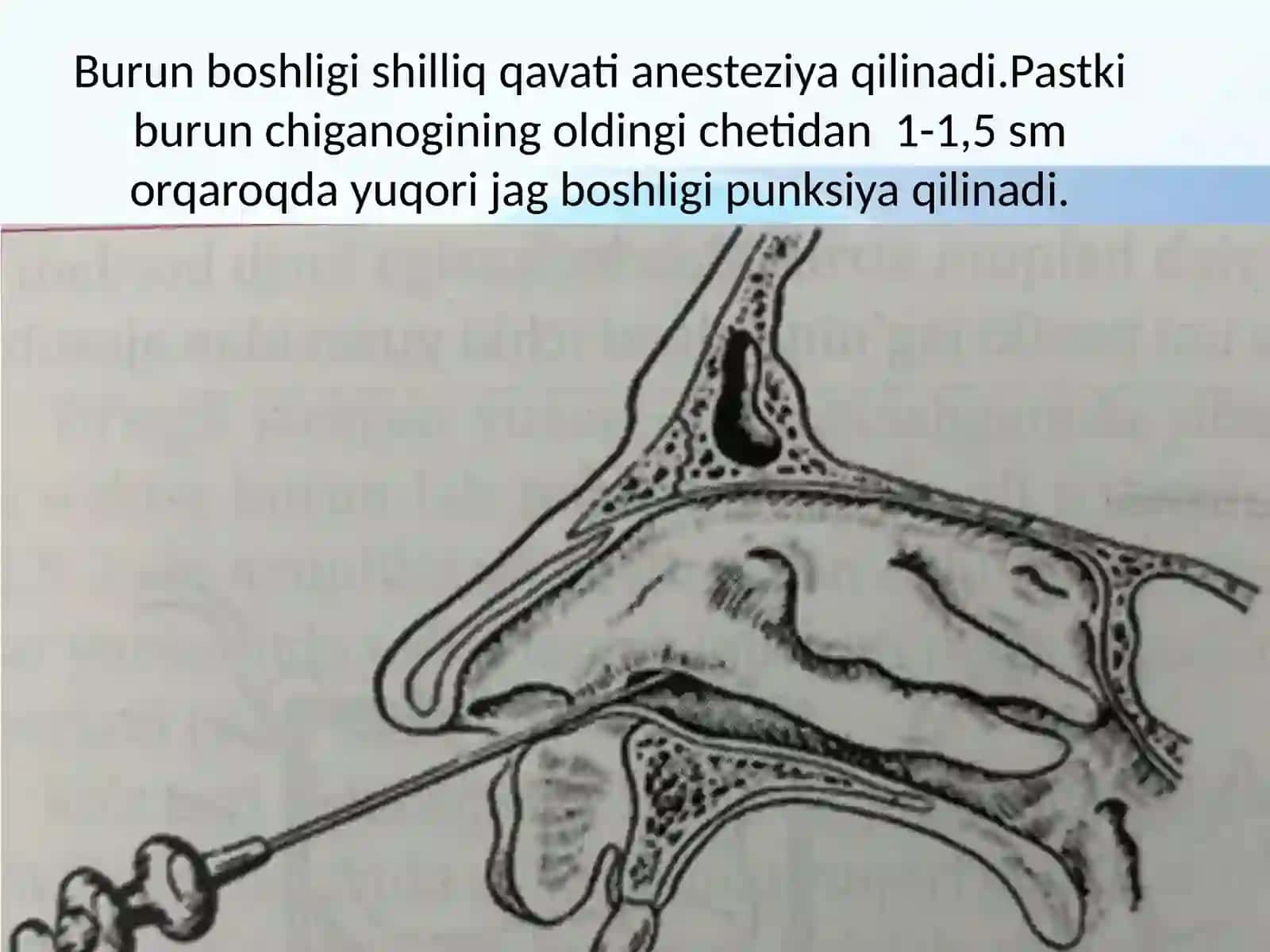 Odamanatomiyasi va OXTA burunyondoshboshliqlaridabajariladigan operatsiyalar 4