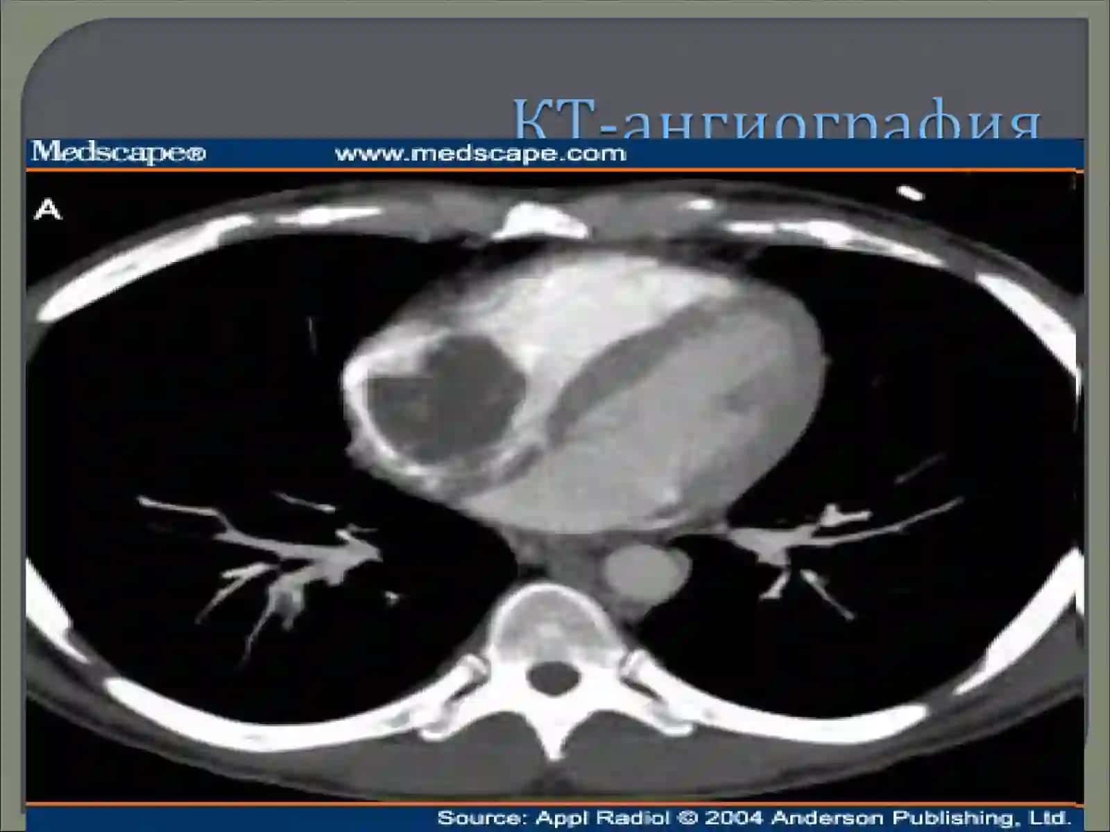 YURAK-QON TOMIRLARI KASALLIKLARIDA KOMPYUTER TOMOGRAFIYANING AXAMIYATI 4