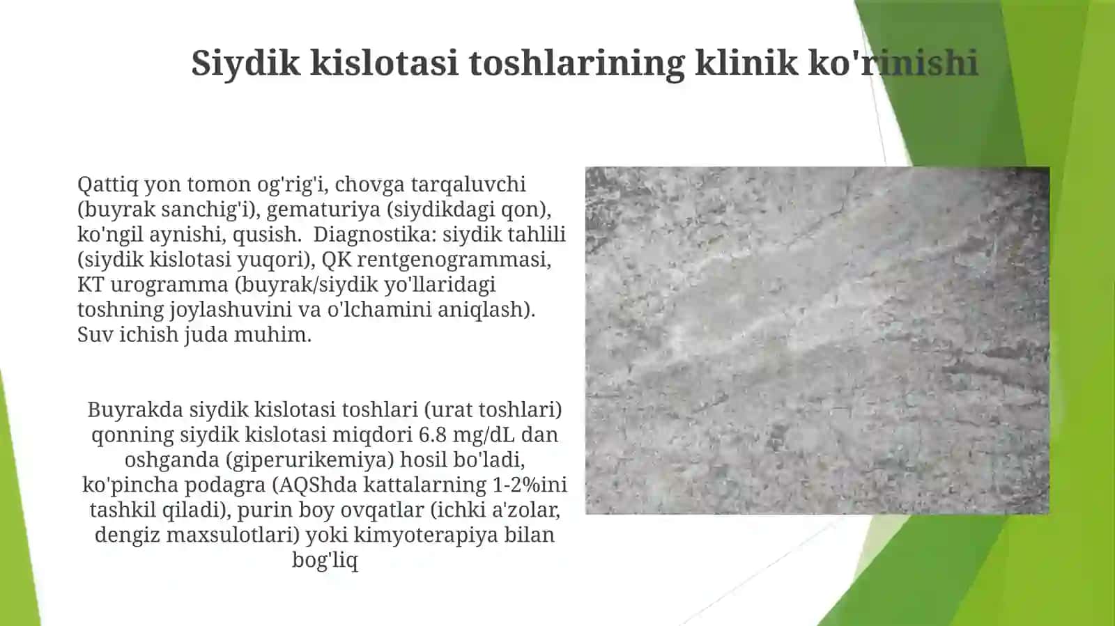 Siydik kislotasi toshlarining jarrohlik davolash usullari 4
