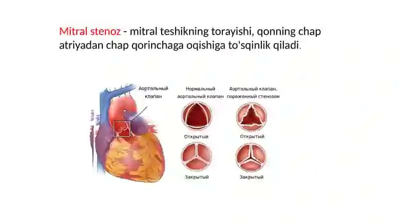 Yurak mitral va aortal nuqsonlar 4
