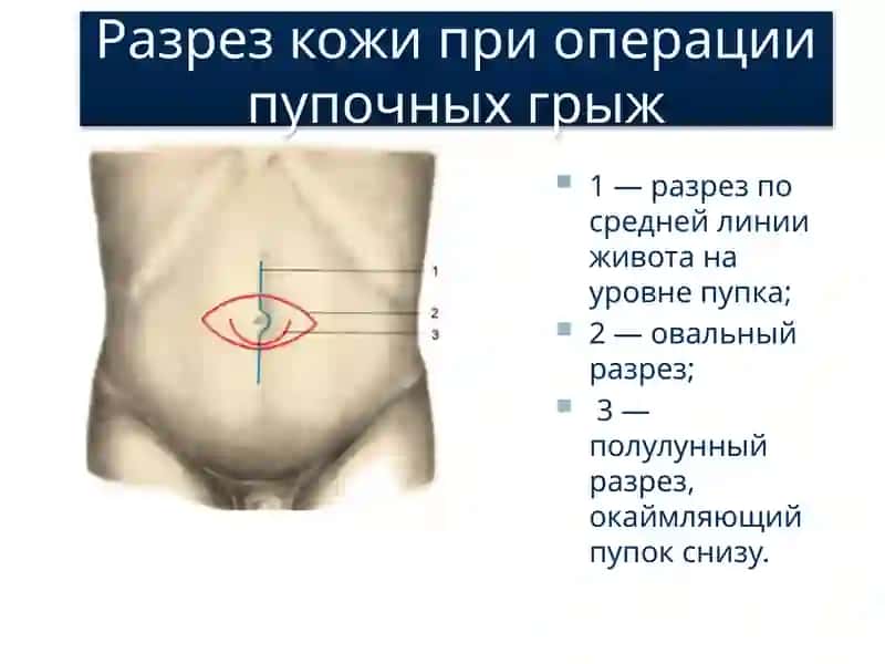 Классические методики оперативного лечения грыж передней брюшной стенки 4
