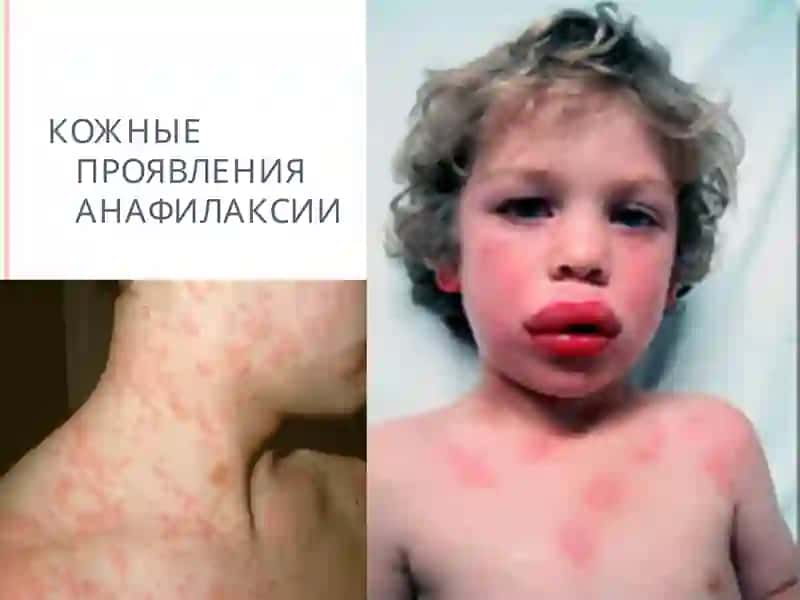 АНАФИЛАКТИЧЕСКИЙ ШОК 4