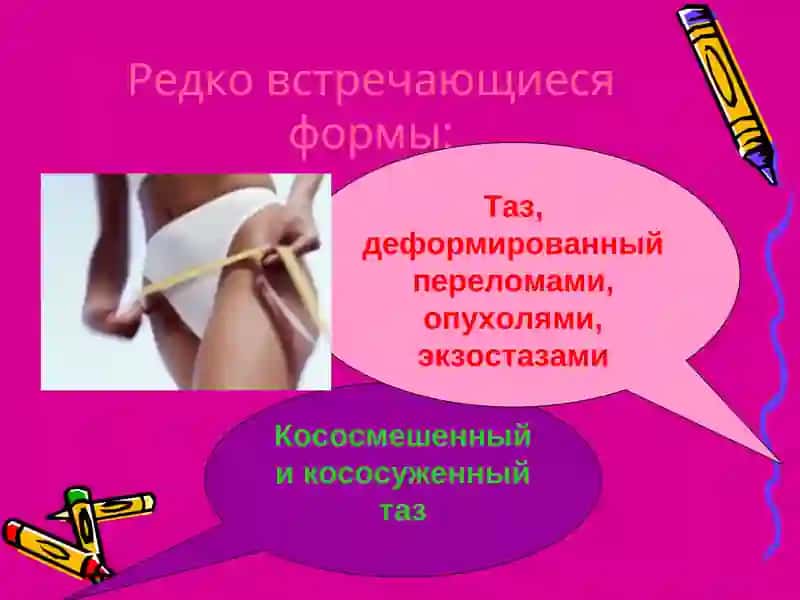 Узкий таз 4