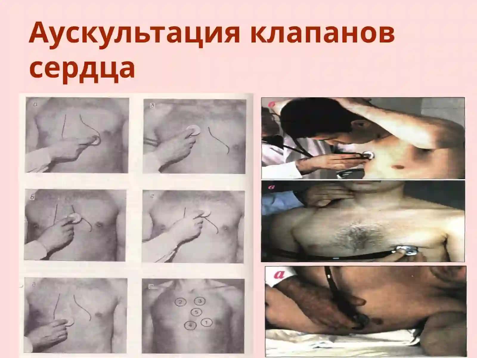 АУСКУЛЬТАЦИЯ СЕРДЦА.ТОНЫ СЕРДЦА В НОРМЕ И ПАТОЛОГИИ.ШУМЫ СЕРДЦА 4