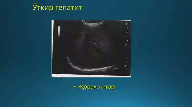 Jigar reziksiyasi 4