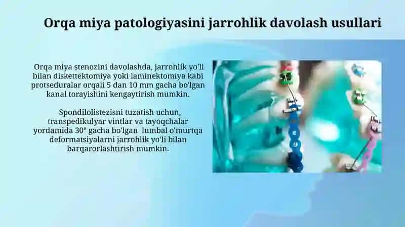 Umurtqa pogʻonasi patalogiylarini operativ davolash usullari 4