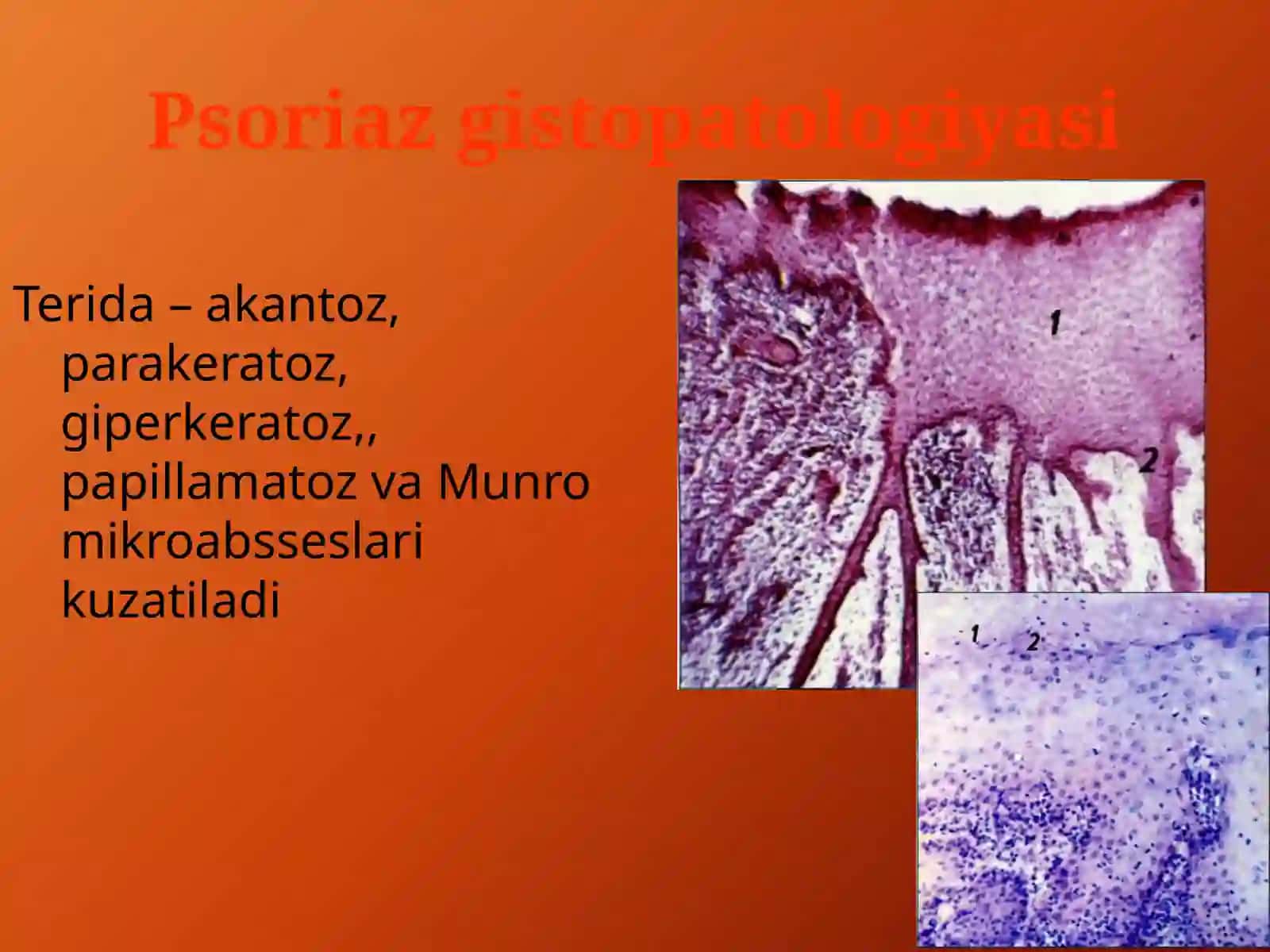PSORIAZ va QIZIL YASSI TEMIRATKINING ATIPIK TURLARI 4