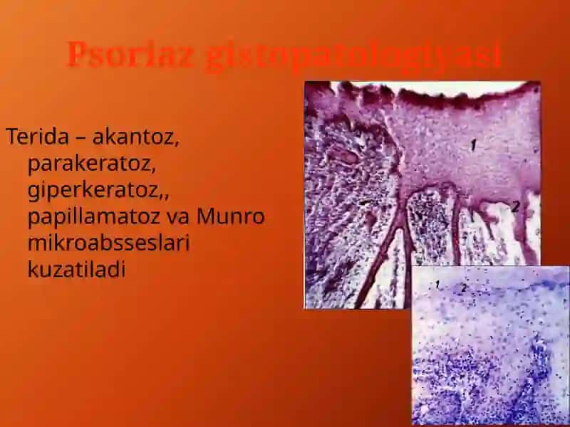 PSORIAZvaQIZIL YASSI TEMIRATKININGATIPIK TURLARI 4