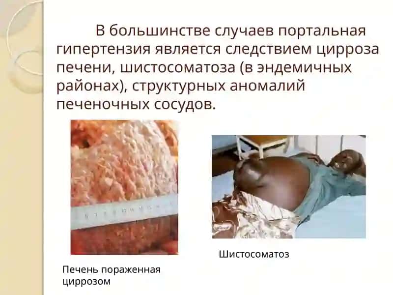 Портальная гипертензия 4