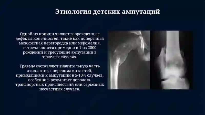 Особенности ампутаций у детей 4