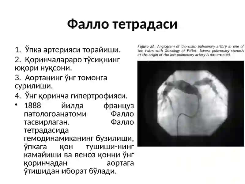 Tug’mayurak nuqsonlari 4