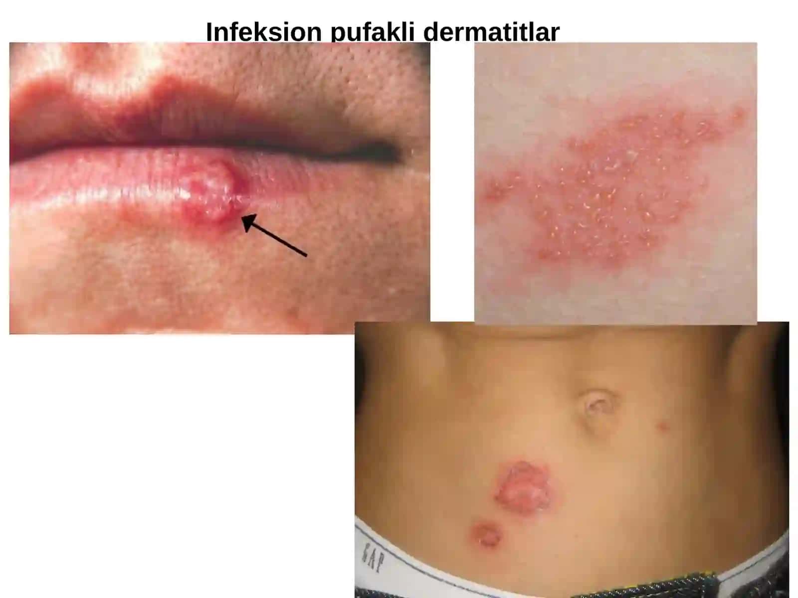 Pufakli dermatitlar klassifikatsiyasi. Diuring dermatiti, po’rsildoq yara 4