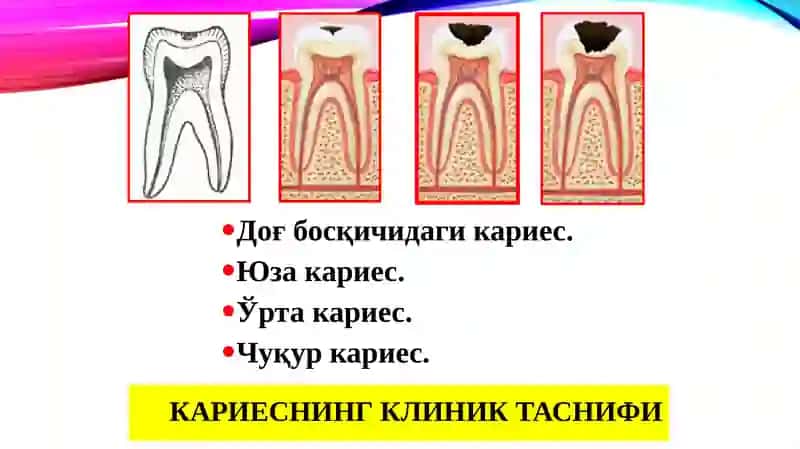 Чархлашнинг минималинвазив усуллари 4