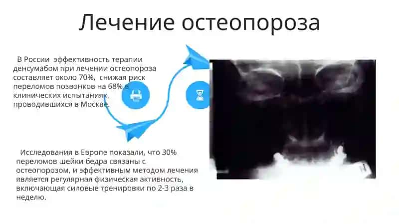 Остеопороз 4