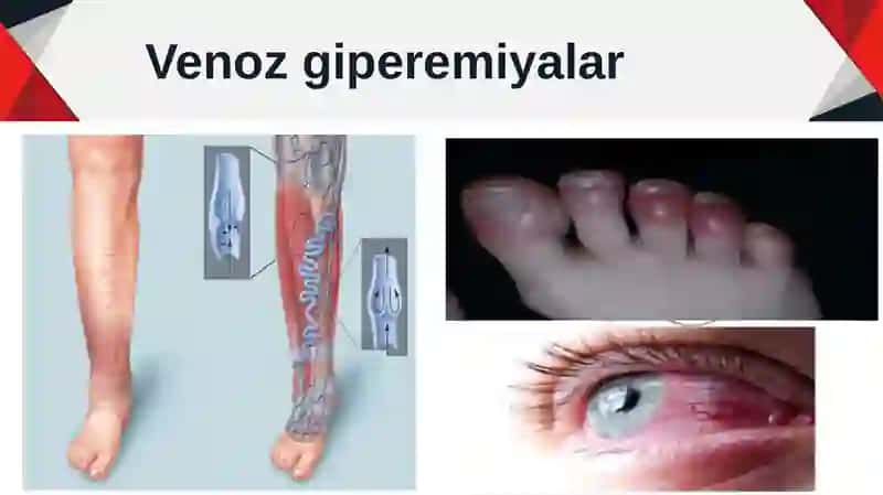 Vena va limfatomlar dastlabki va oz vaqtincha davolash usullari 4