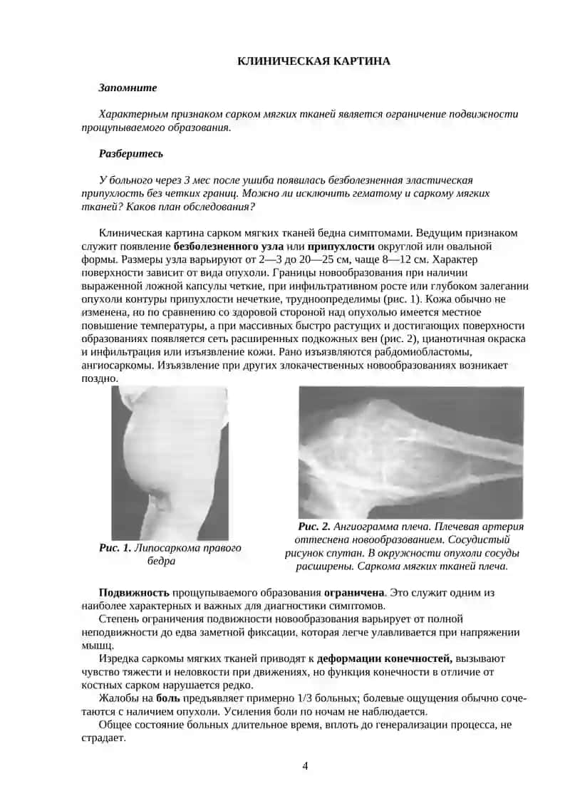 Саркомы Мягких Тканей 4