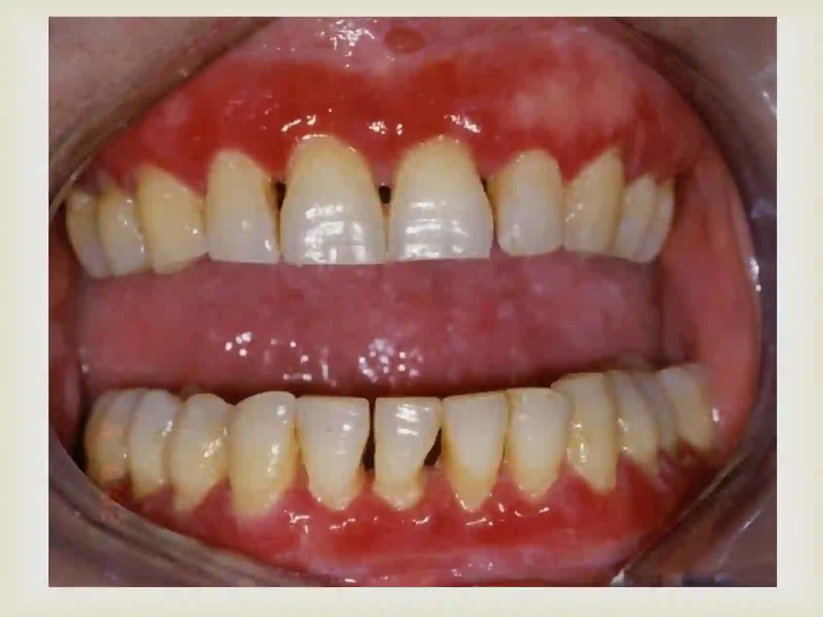 Deskvamativ gingivitlarni klinikasi,diagnostikasi qiyosiy tashxisi, davolash, profilaktikasi. Kasallik tarixini yozish. 4