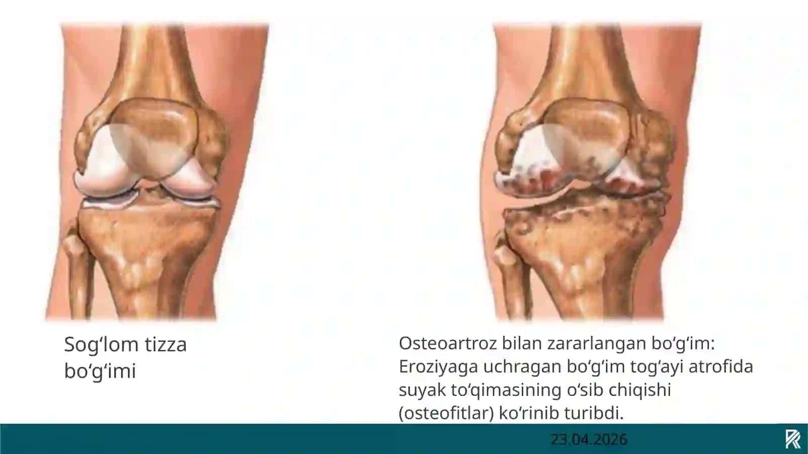 Deformatsiyalovchi Osteoartroz 4