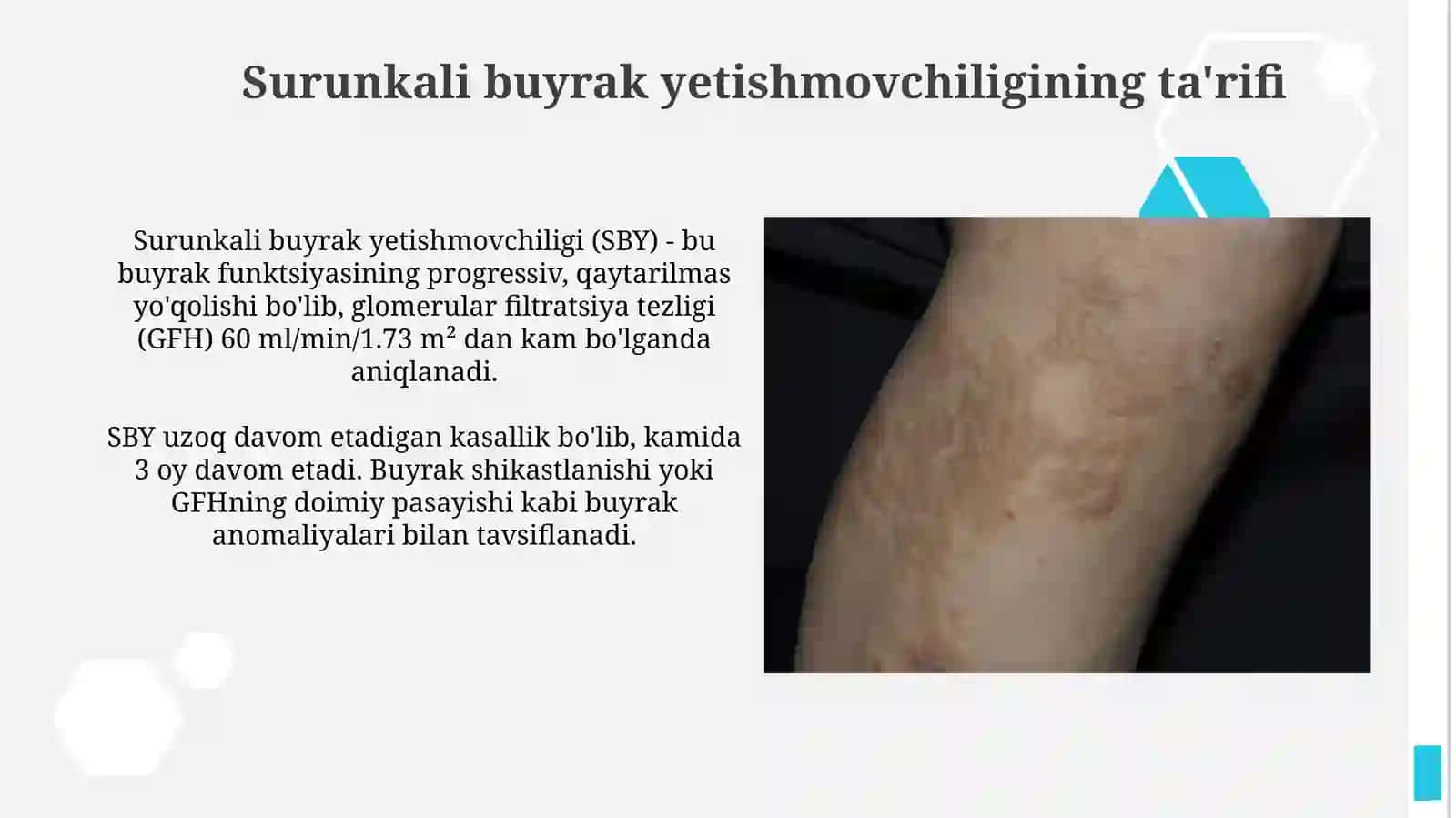 Surunkali buyrak yetishmovchiligietiologiyasi, patogenezi, tasnifi, kliniksindromlari 4