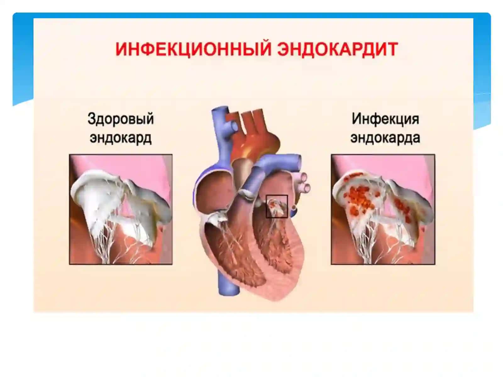 Инфекцион эндокардит 4