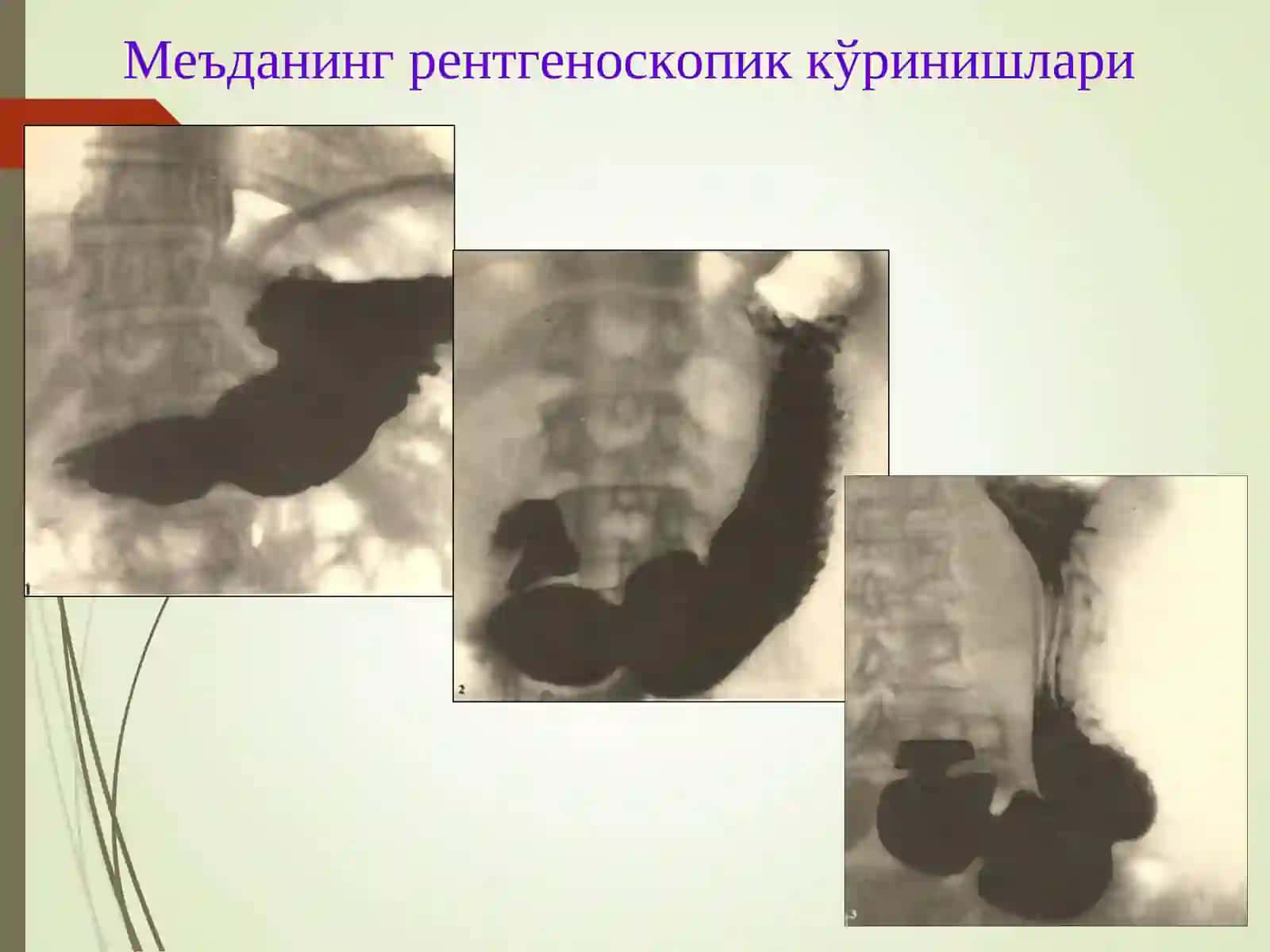 МЕЪДА ВА 12 БАРМОҚЛИ ИЧАК ЯРА КАСАЛЛИГИ 4