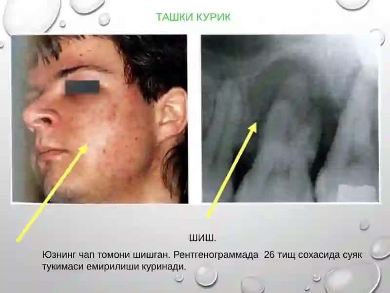 Perkussiya turlari. Patologik periodontal chontakning chuqurligini aniqlash. Tishlarning patalogik harakatchanligi, uning darajalari. 4