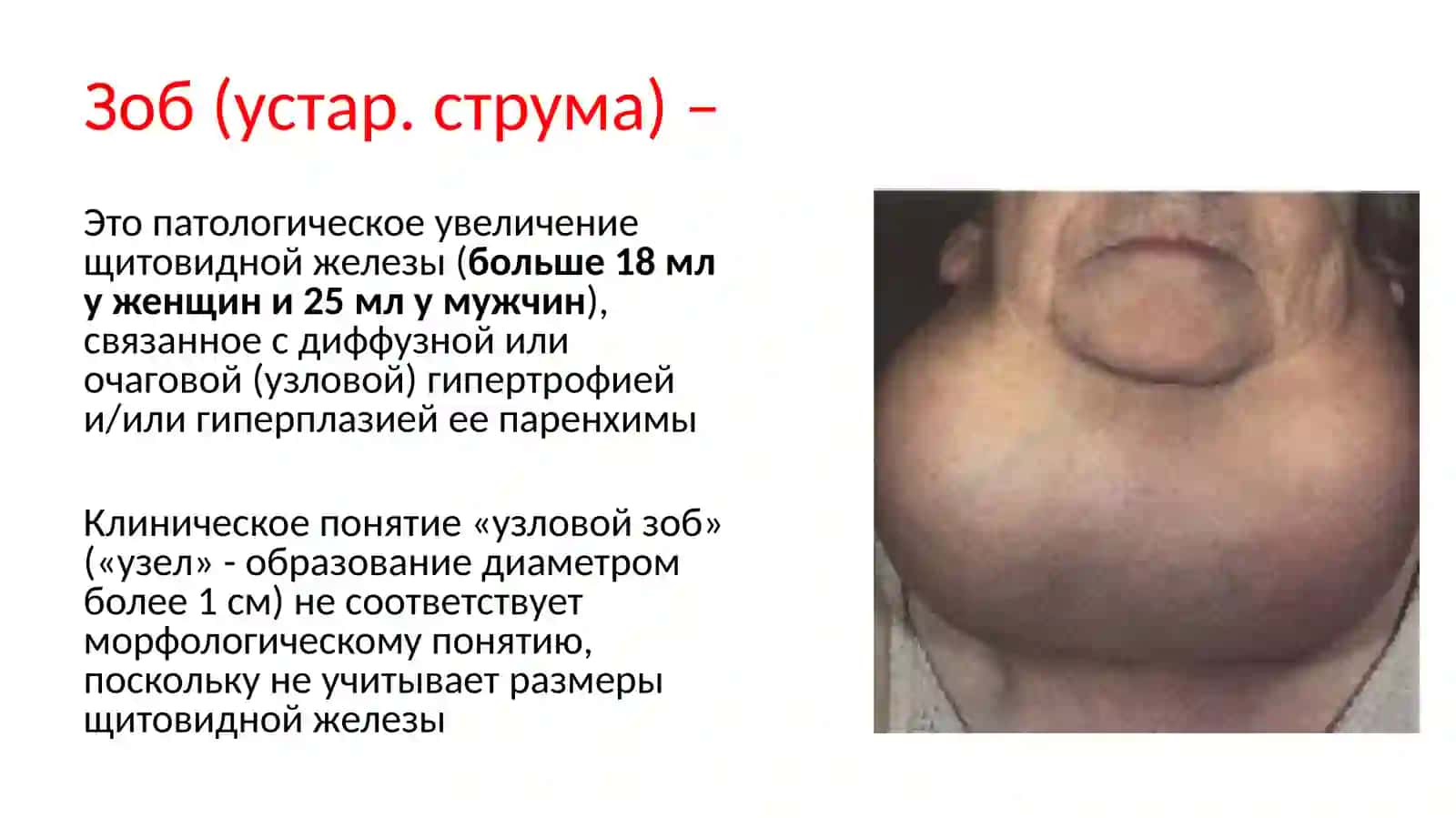 БолезньГрейвса 4