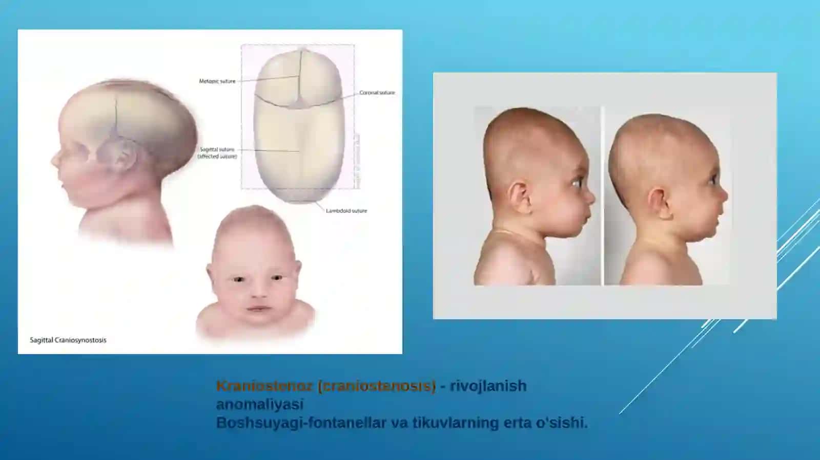 Bosh va orqa miya tug’marivojlanish nuqsonlari 4