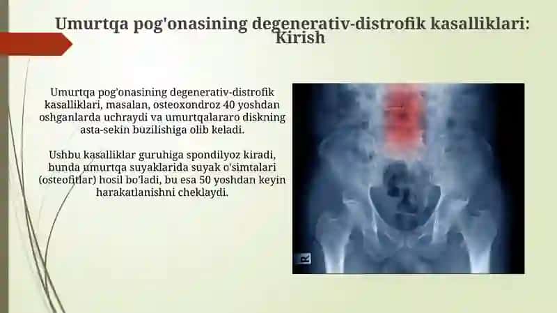 Umurtqa yallig‘lanish va degenerativ-distrofik kasalliklari 4