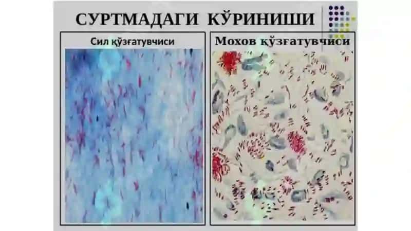 Moxov kasalligi 4