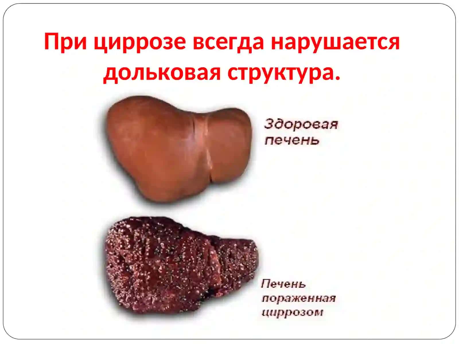 Цирроз печени 4