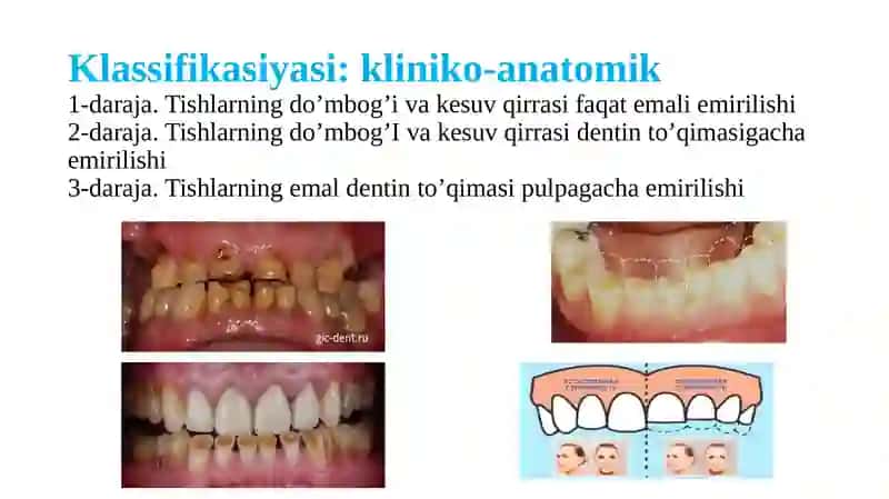 Tish chiqqandan keyingi nokariyes kasalligi 4