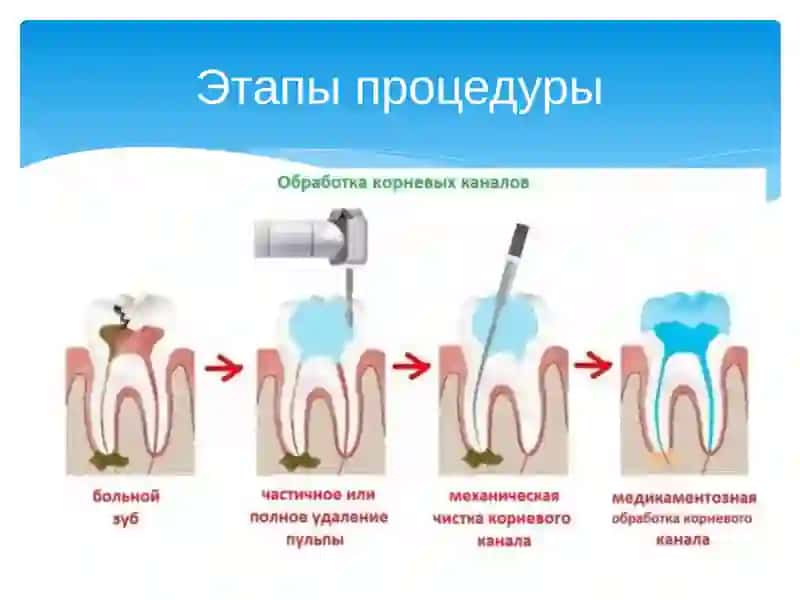 Метод пломбирования корневых каналов термофилом 4