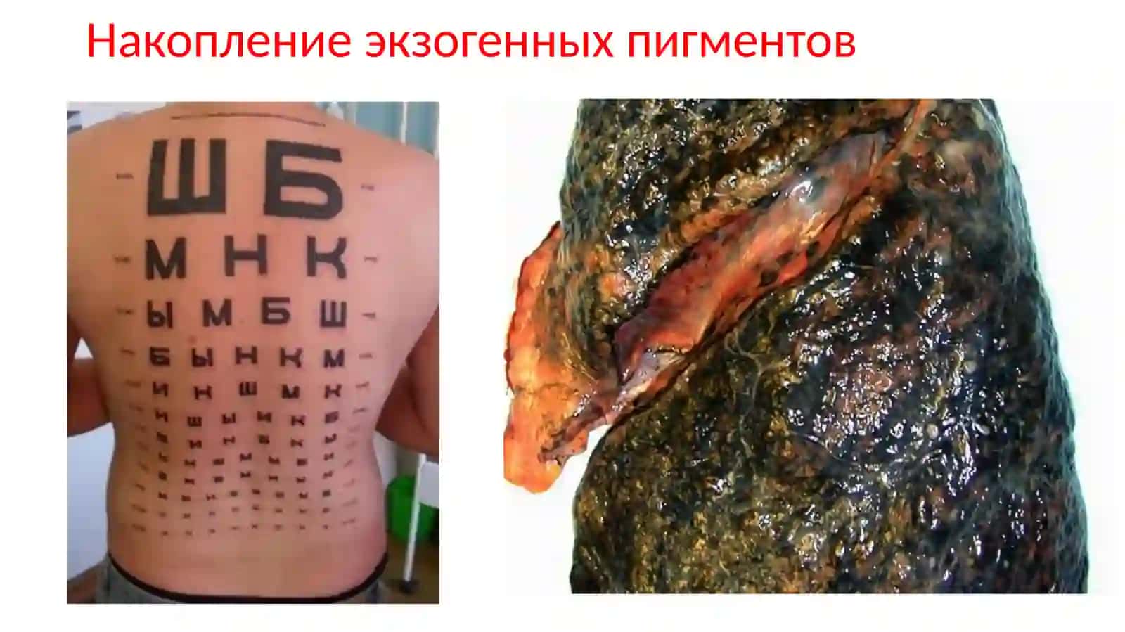 Нарушения обмена пигментов 4