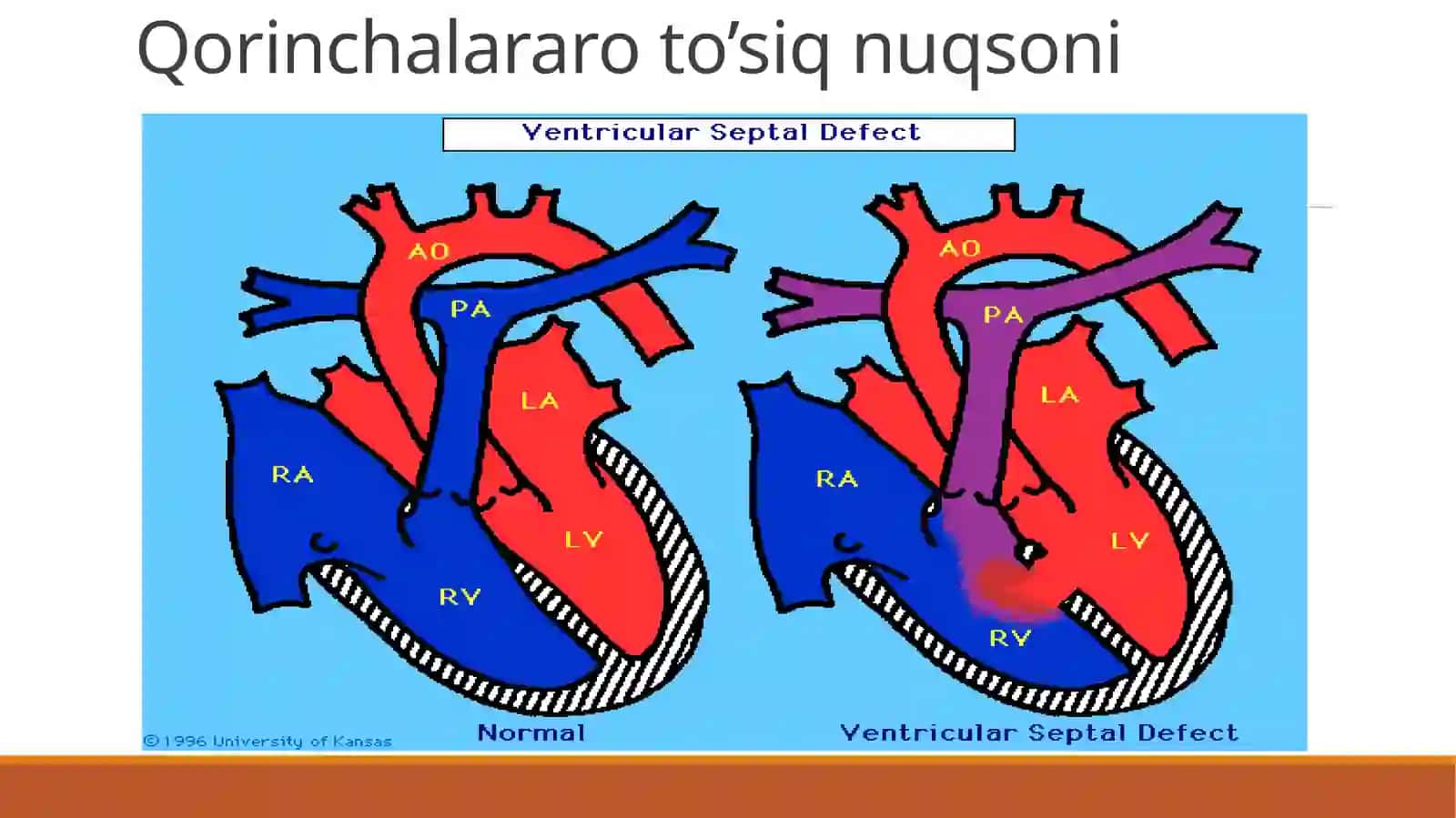 Yurak poroklari (nuqsonlari) 4