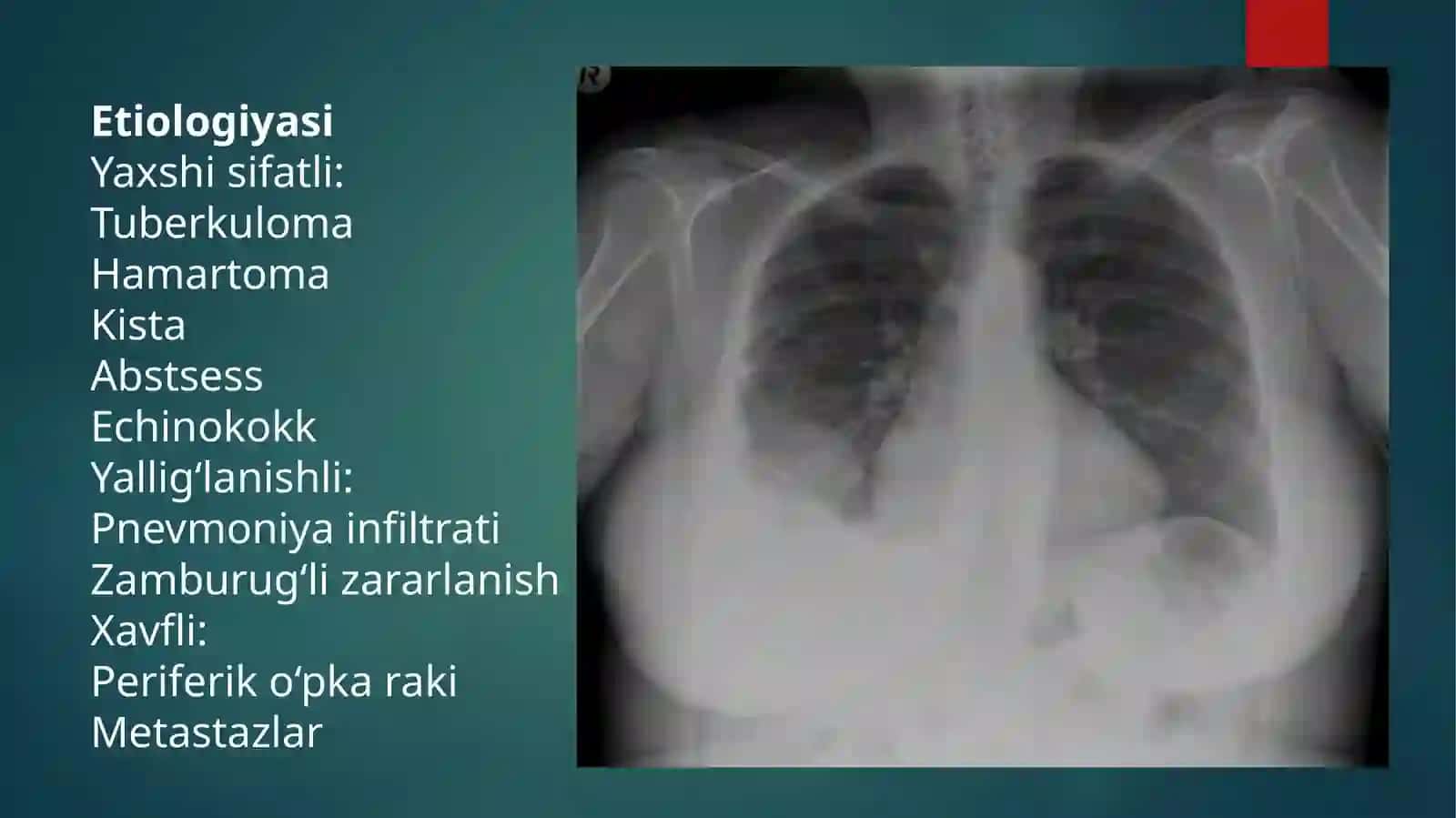 Oʻpka ichidagi yumaloq soyani tashxislash 4