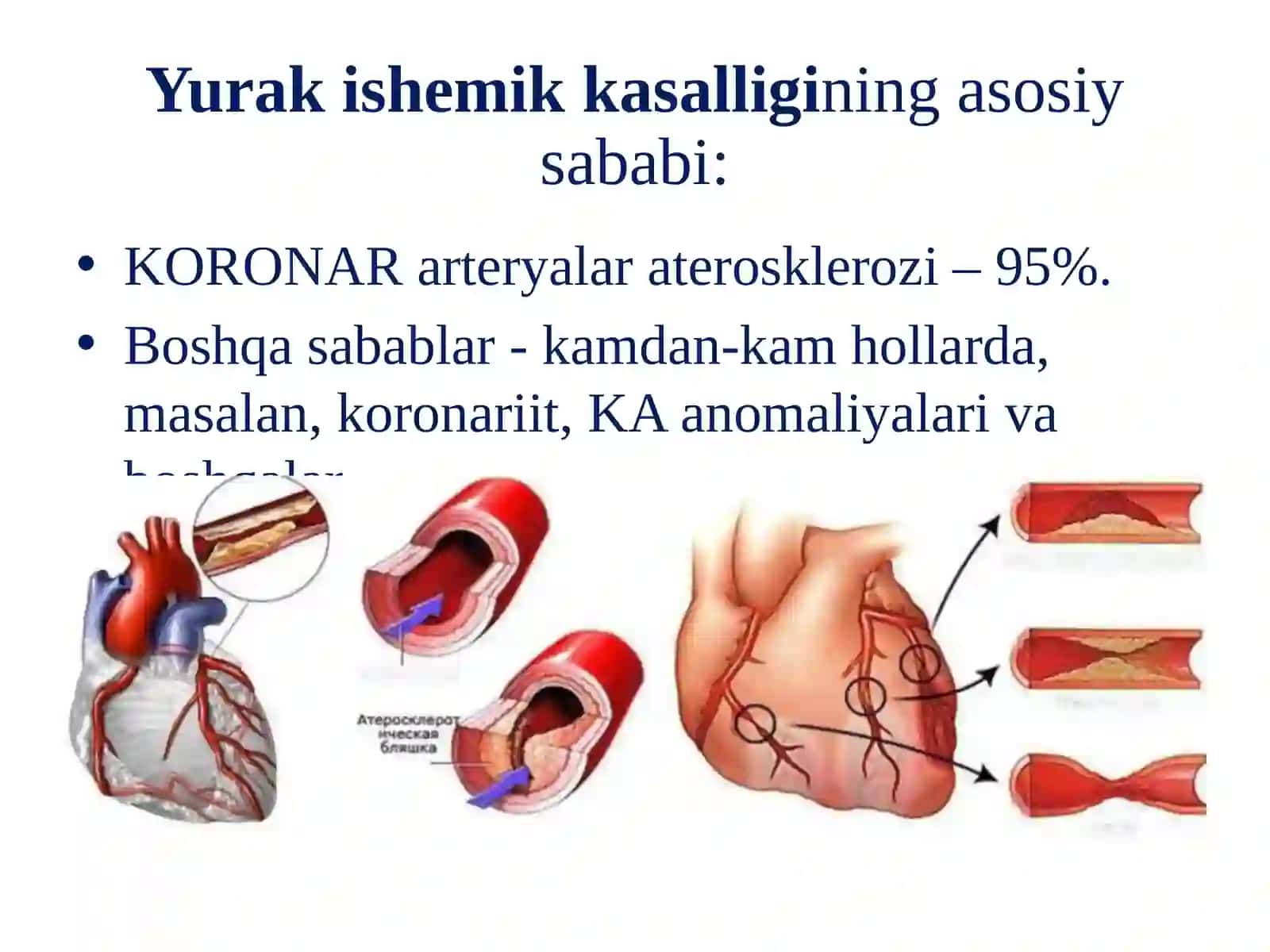 Yurak ishemik kasalligi 4