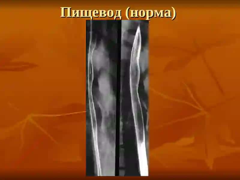 Лучевая диагностика заболеваний желудочно-кишечного тракта 4