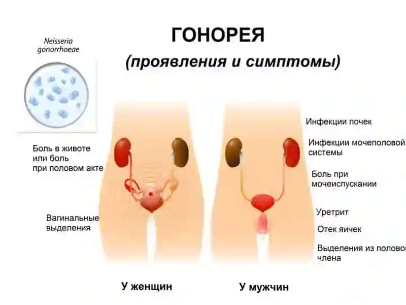 Сўзакнинг Чақирувчиси (Neisseria gonorrhoeae) 4