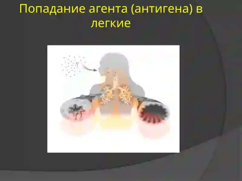 БРОНХИАЛЬНАЯ АСТМА: ОПРЕДЕЛЕНИЕ, ЭТИОЛОГИЯ, ПАТОГЕНЕЗ 4