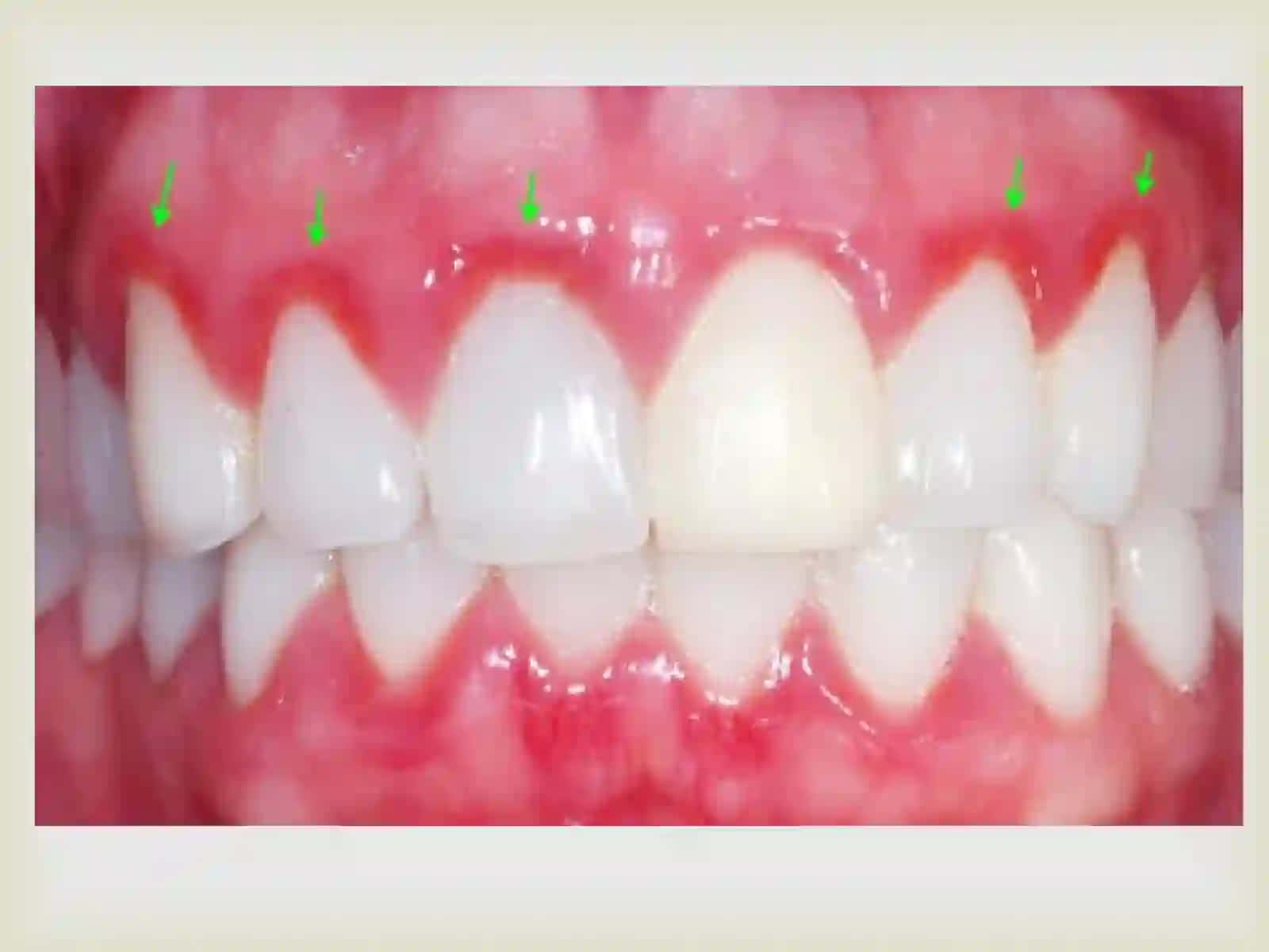 Atrofik gingivitni klinikasi,diagnostikasi, qiyosiy tashxisi, davolash, profilaktikasi. Kasallik tarixini yozish. Kasallik tarixini yozish. 4