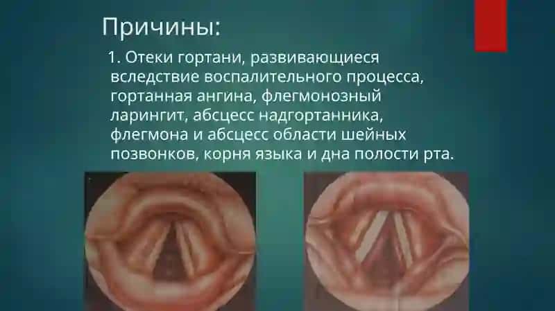 Острые и хронические заболевания гортани 4