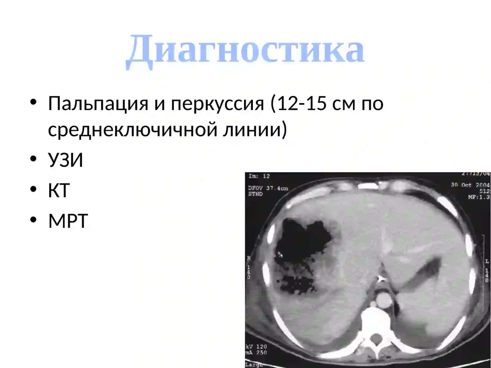 Гепатомегалия — это патологический симптом, обозначающий истинное увеличение размеров печени. 4