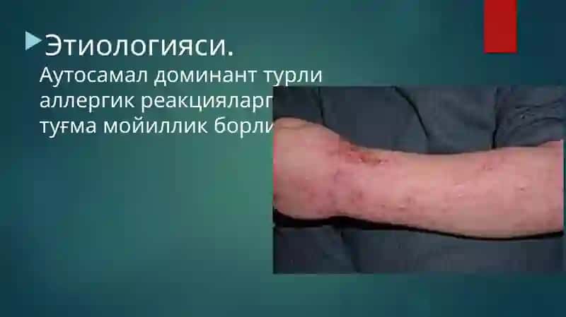 Atopikdermatitlar 4