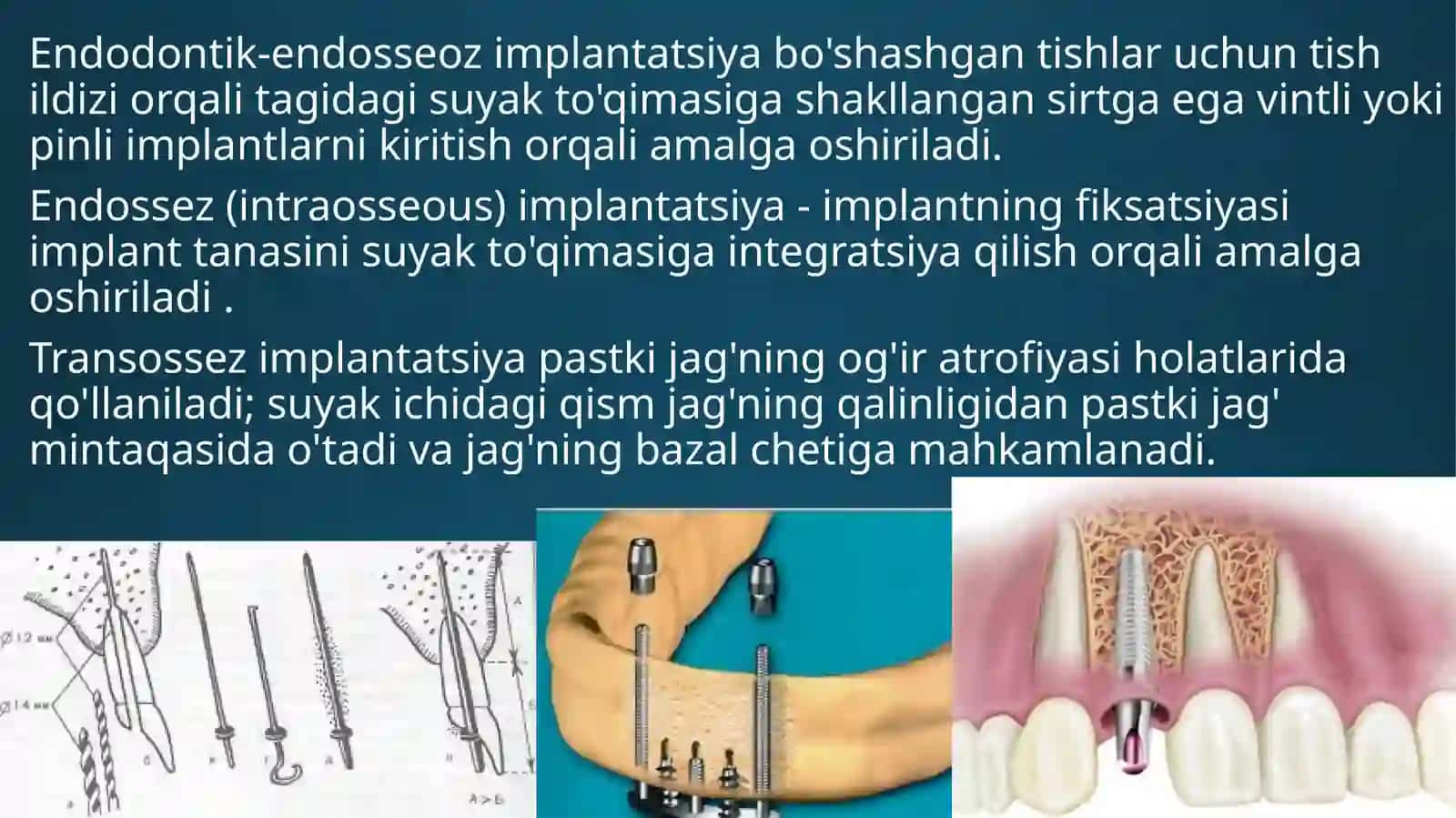 " Implantlardagi olinadigan protezlarni mahkamlash " 4