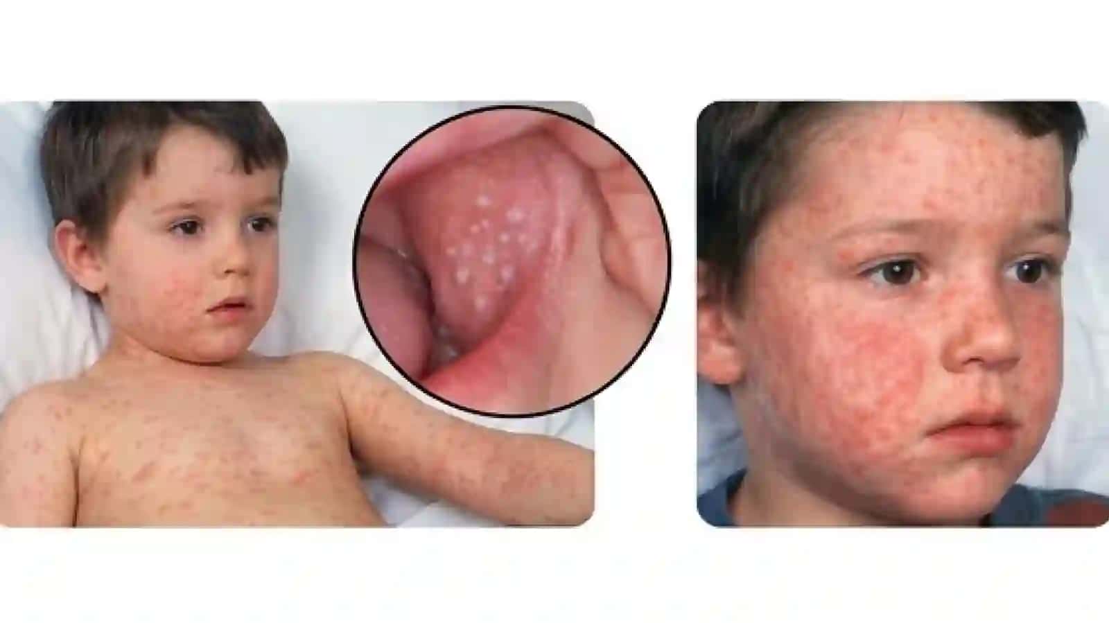 Pediatriya qizamiq, qizilcha, suvchechak 4